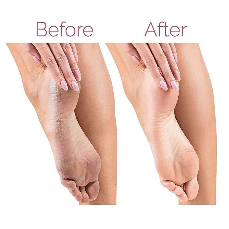 Electric Pedicure Foot File Callus Remover  جهاز إزالة الجلد الميت والعناية بالقدمين الكهربائي